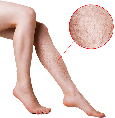 Silhouette - Varices