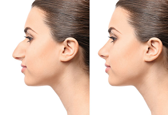 Rhinoplastie