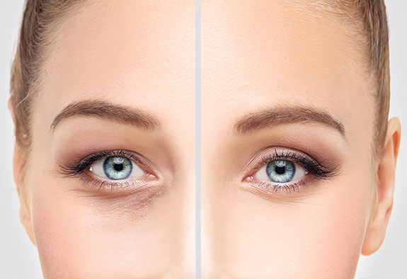 blépharoplastie blépharoplastie