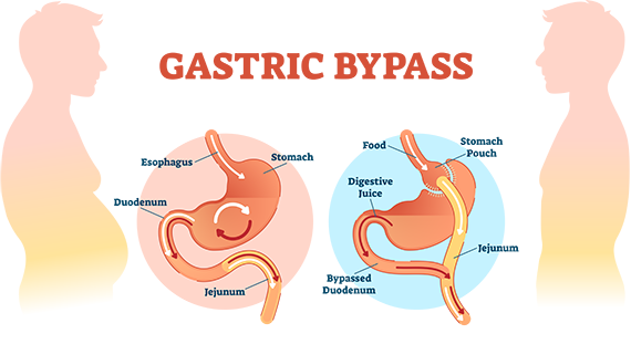 Bypass Gastrique