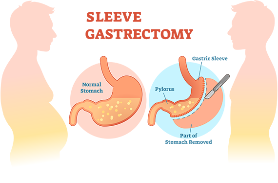 Sleeve Gastrique