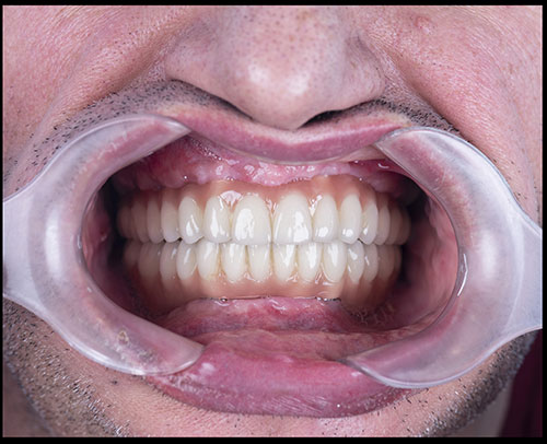 Dentisterie esthétique - implant dentaire