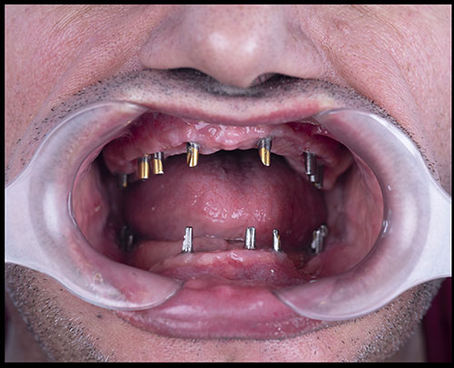 Dentisterie esthétique - implant dentaire